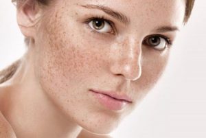 Kem đặc trị nám tàn nhang của Nhật cho phái đẹp loại nào tốt?