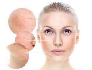 Cách bôi kem trị nám tàn nhang sau sinh của Nhật cho mẹ bỉm