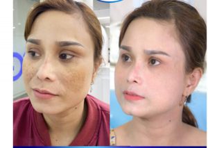 Bí quyết chọn kem trị tàn nhang tốt nhất hiện nay của Nhật