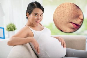 cách phòng tránh nám da khi mang thai